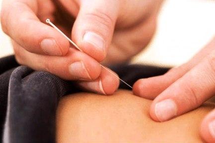 Tratamientos de acupuntura